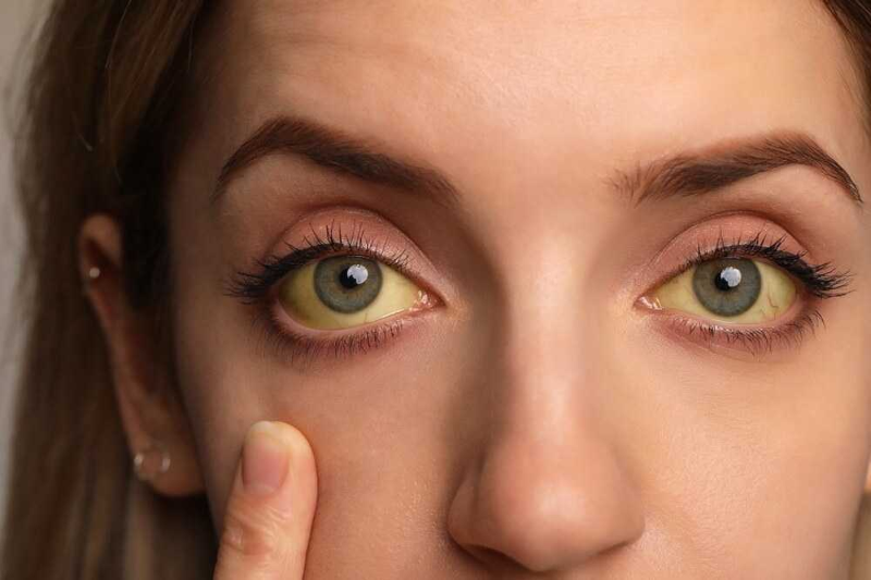 Amazon Yellow Fever